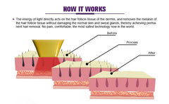 Aparat Epilare Definitiva si PicoSecond Second 532, 1064nm, Cellular ND YAG Pico Laser Profesional, Indepartare Tatuaje, 2 manipuli 755, 808, 1064nm 1600W Dioda Laser, 50mil Impulsuri ICEPlatinumPRO