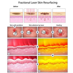 Aparat Laser Fractional Co2 Glass 10600nm Skin Resurfacing Lifting, Indepartare Vergeturi, Cicatrici, Anti Acnee, Intretinere si Rejuvenare Vaginala