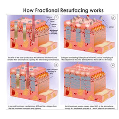 Aparat Laser Fractional Co2 60W 10600nm Skin Resurfacing Lifting, Indepartare Vergeturi, Cicatrici, Anti Acnee, Intretinere