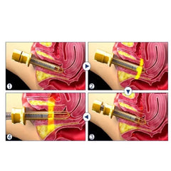Aparat Laser Fractional Co2 Glass 10600nm Skin Resurfacing Lifting, Indepartare Vergeturi, Cicatrici, Anti Acnee, Intretinere si Rejuvenare Vaginala