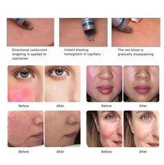 Aparat Dioda Laser 980nm Indepartare venectazii, Vase capilare sparte, Indepartare Vene panza de paianjen, Venom II + Ciocan Rece