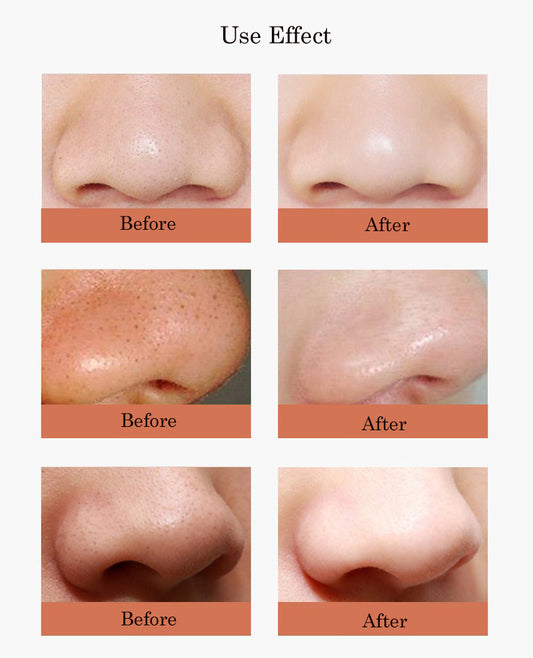 Aparat Indepartare Puncte Negre Blackhead Remover LCD, Aparat Multifunctional Facial Pore Cleaner Peeling, Anti Acnee, Rose