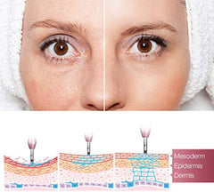 Aparat Reglabil Injectare Acid Hyaluronic Hyaluron Pen, Inalta Presiune, Precizie, Stilou Atomizare Marire Buze, Lifting AkaAy White