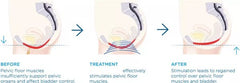 Perna Pelvis Ems Hiemt Electromagnetic Electrostimulare, Muscle Trainer Model cu RF