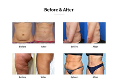 Aparat All in One Vacuum Lipolaser Profesional Indepartare Celulita, Aparat de slabit Cavitatie 2.0, 3D Smart Bipolar RF, Dermabraziune & Vacuum Spray & Bio YH-9801S
